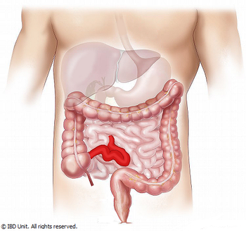 What to Know About Crohn's Disease and Colitis